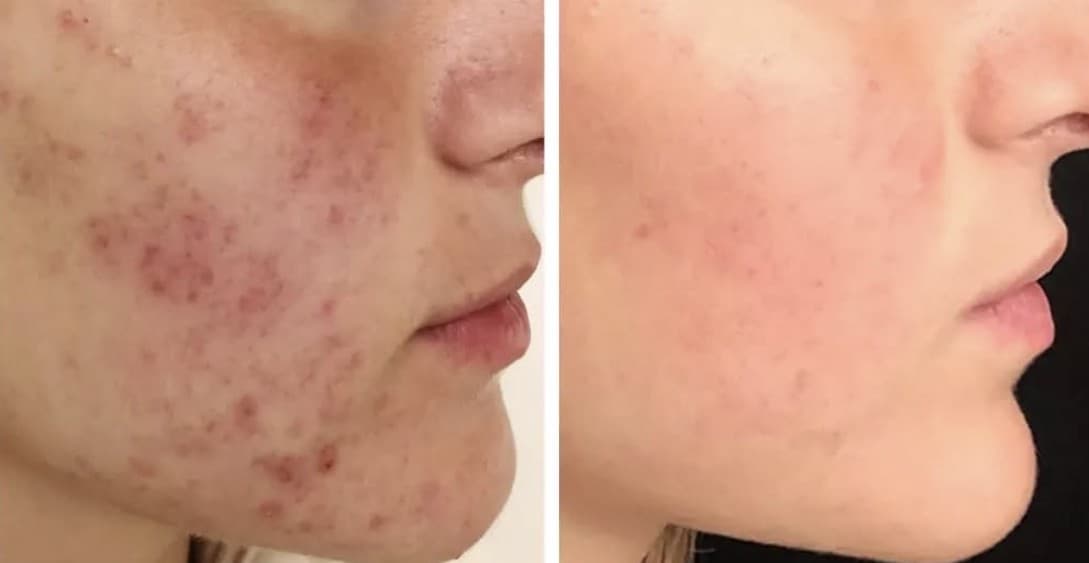 acne-e-cicatrici
