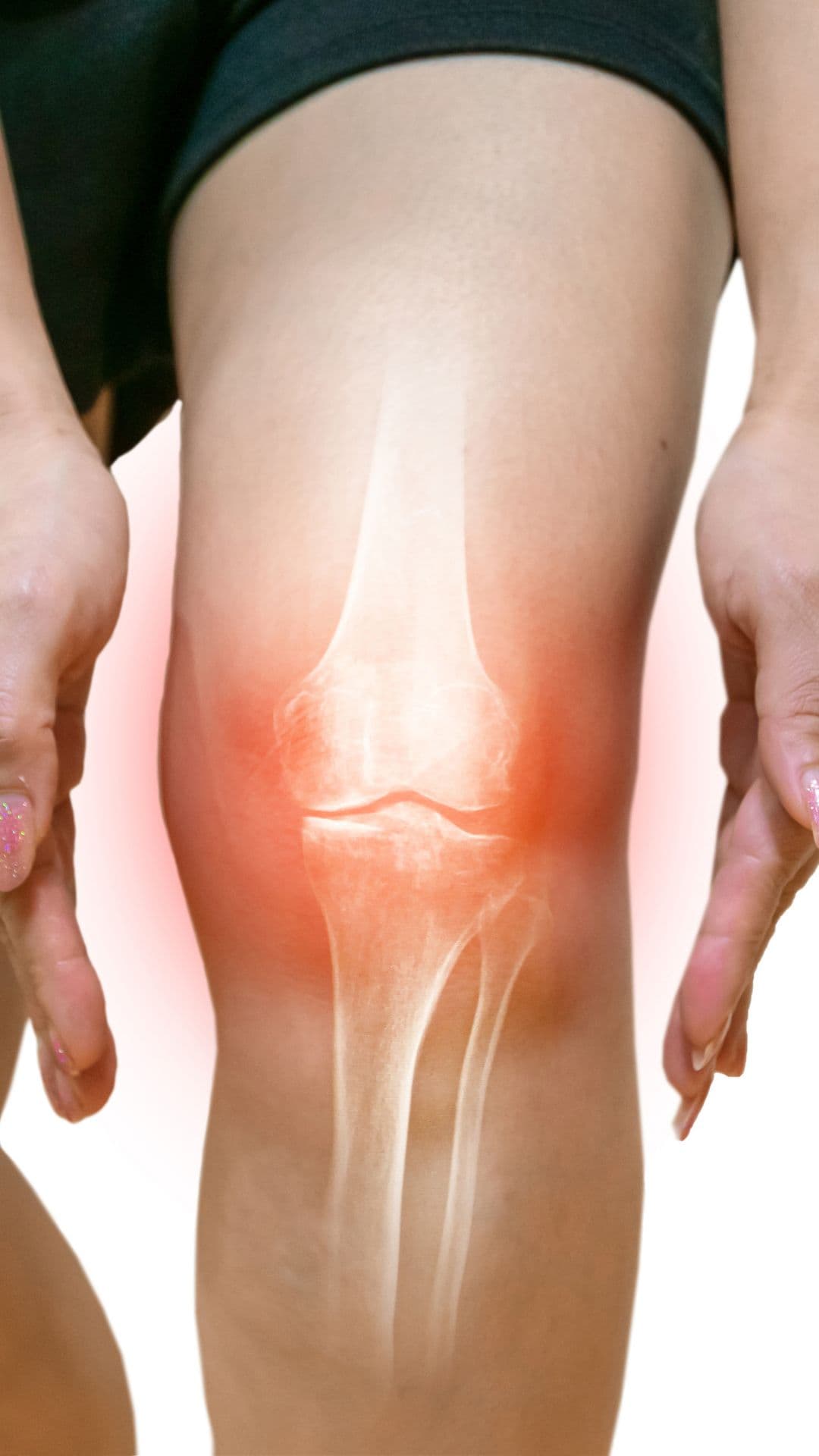 Artrosi: come si cura con la medicina rigenerativa?