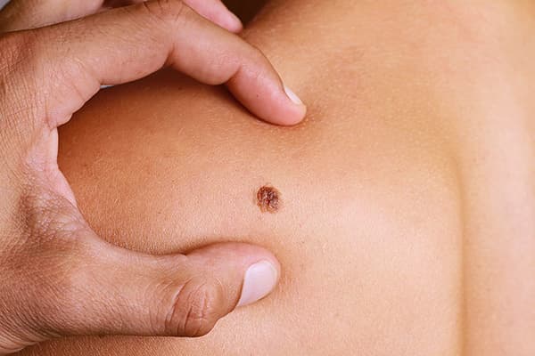 Nei della pelle: i 7 luoghi comuni da sfatare