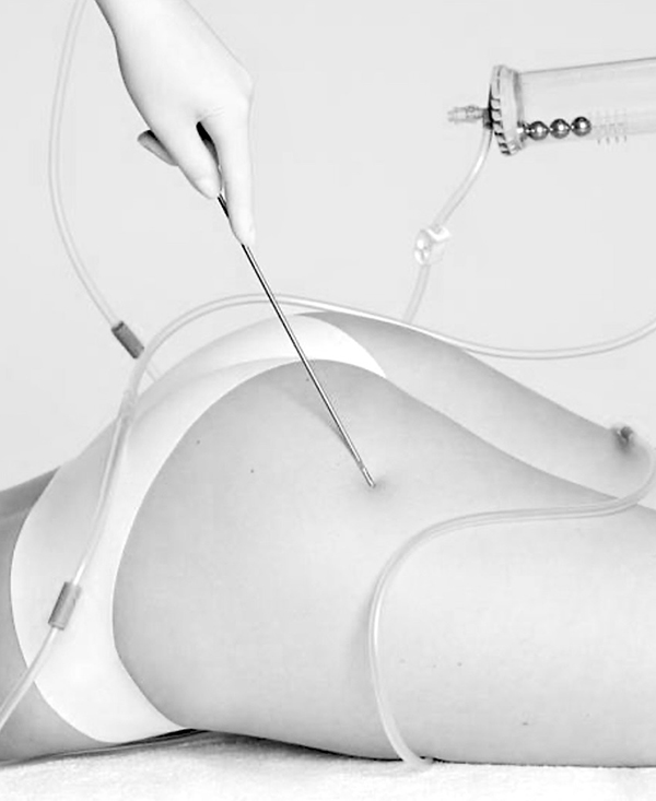 Testimonianza: Lipoaspirazione o Liposuzione? La differenza